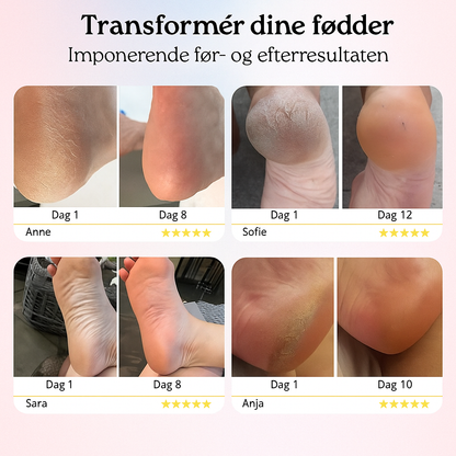 SilkeFod™ Pro 2.0 | Løsningen til babybløde fødder